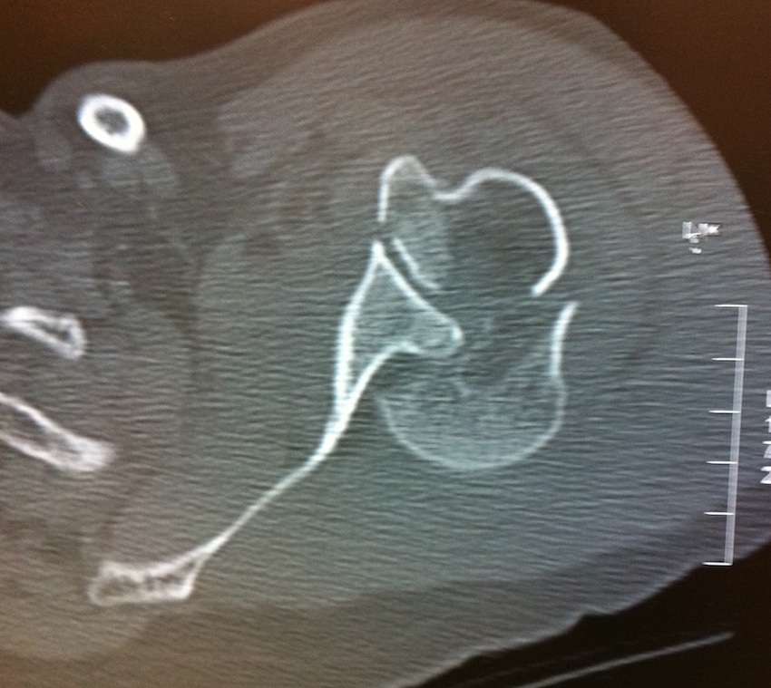 Posterior Shoulder Fracture Dislocation